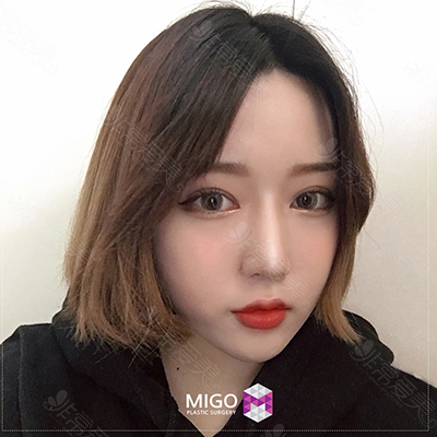 韩国MIGO眼部综合整形术后照片