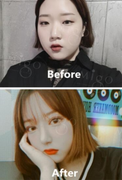 韩国MIGO眼综合手术前后对比照片
