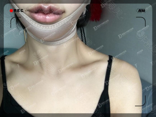 韩国女神医院唇部整形照片