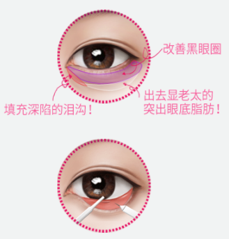 韩国祛眼袋手术示意图