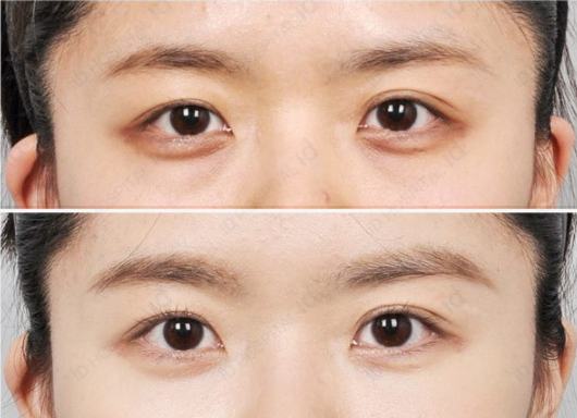 韩国ID祛眼袋手术案例对比图