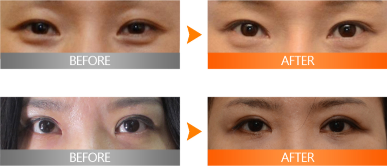 韩国艾源双眼皮修复案例对比