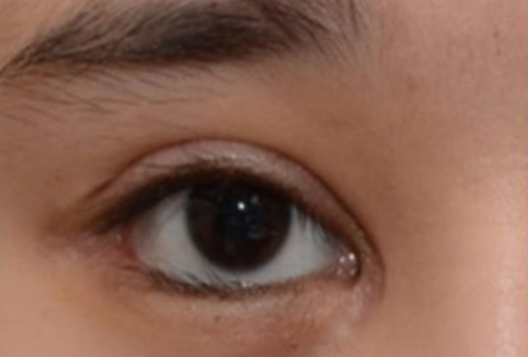 内眼角的括号疤痕怎么修复