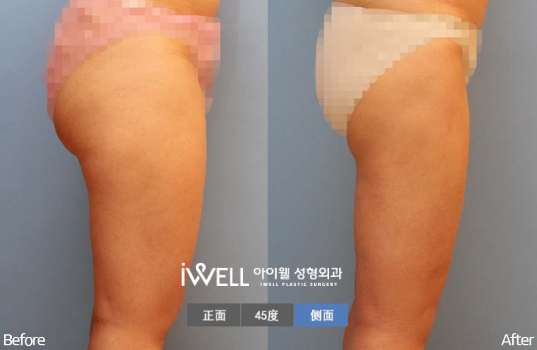韩国爱我臀部吸脂对比案例图