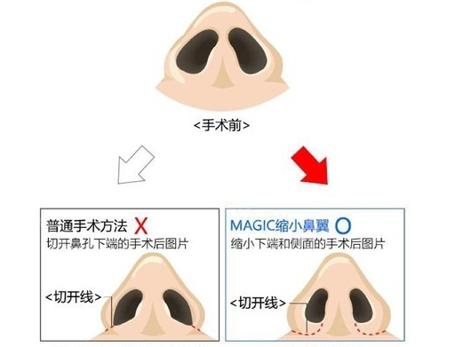 韩国高诺鼻整形医院鼻翼缩小示意图