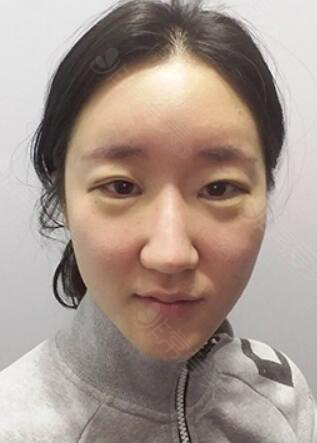 韩国加美整形医院眼鼻修复术前照片