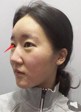 韩国加美整形医院眼鼻修复照片