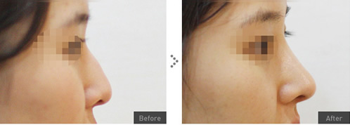 韩国olive整形外科隆鼻案例展示