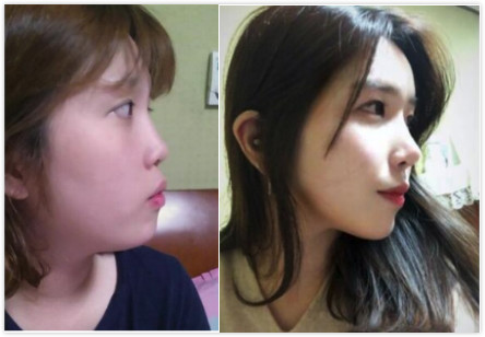 韩国肋软骨隆鼻案例对比
