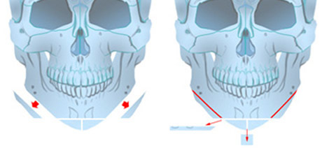 profile整形外科轮廓手术优势分析