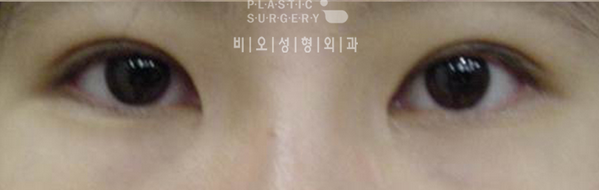韩国BIO整形医院开眼角手术对比后