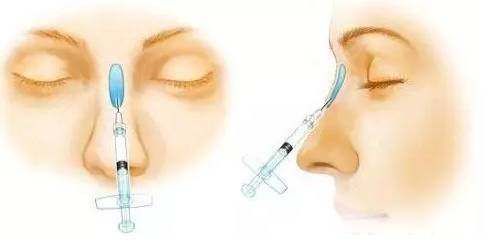 注射隆鼻手术如何