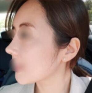 韩国丽丝塔金东奭隆鼻术后照片