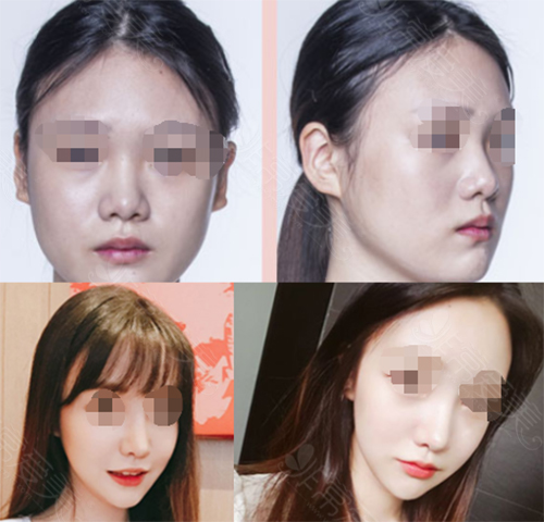 韩国丽丝塔金东奭做鼻子怎么样，和cocoline能比吗？