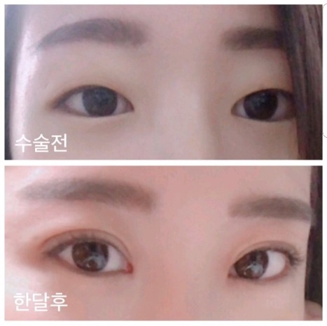 韩国双眼皮手术案例对比