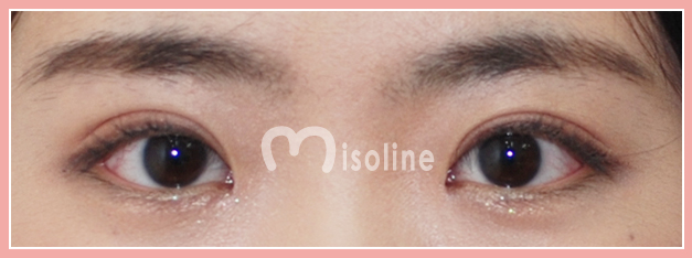 韩国misoline整形外科双眼皮修复日记