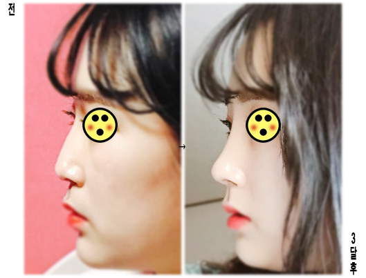 韩国Baroko整形外科鼻整形案例对比