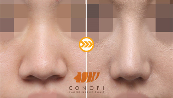 韩国福鼻整形对比图