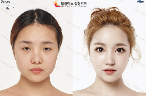 韩国Topclass整形医院隆鼻手术前后对比