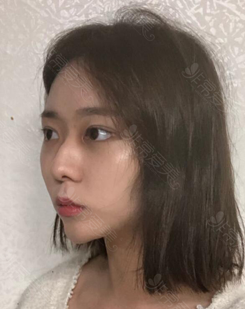 韩国普瑞美女生驼峰鼻矫正术前照片