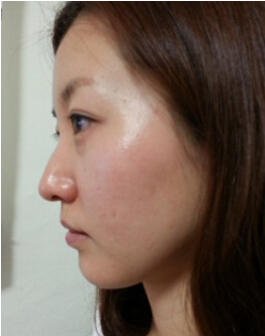 韩国巴诺巴奇驼峰鼻整形术前照片