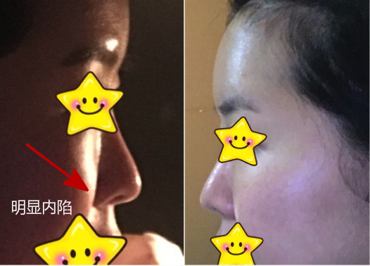 韩国博朗温整形外科小猪鼻整形对比