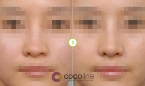 韩国cocoline医院鼻梁歪斜矫正前后对比照片