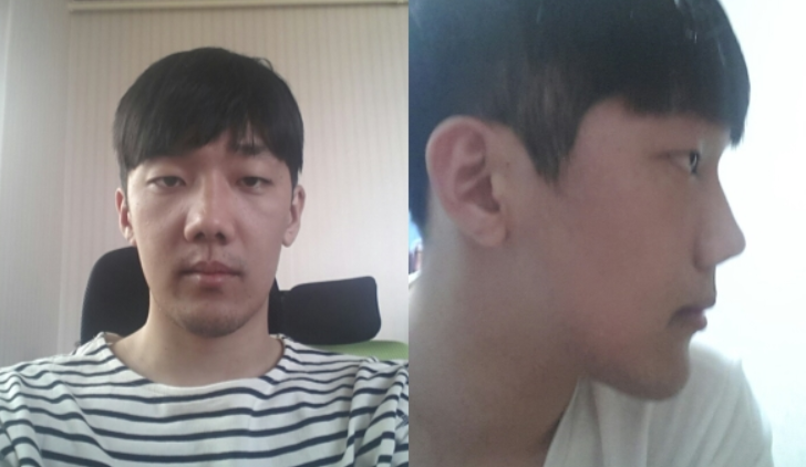 韩国profile男生成型记，眼鼻轮廓综合整形效果超赞！