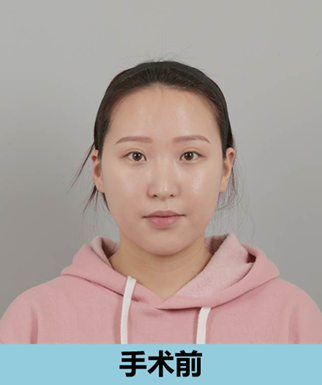 韩国ID整形医院面部吸脂术前照片