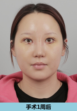 韩国ID医院面部吸脂术后7天恢复图