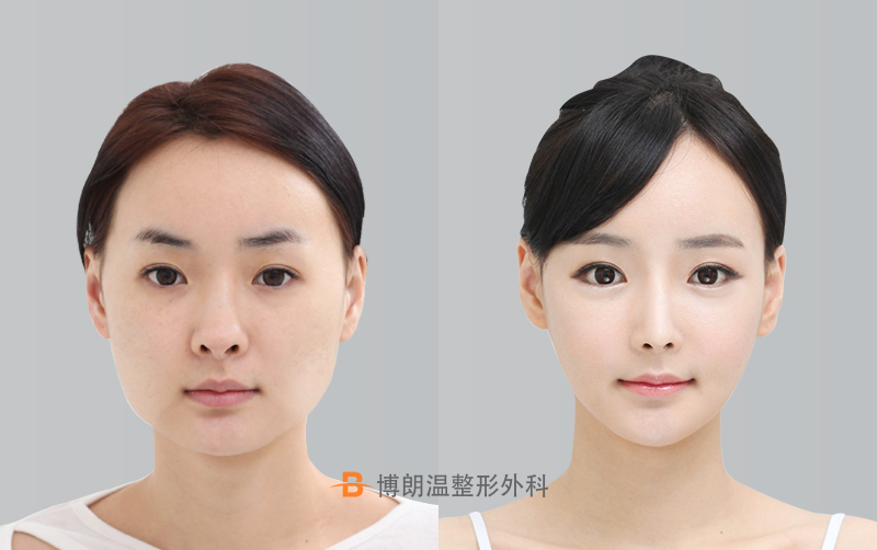 面部轮廓整形手术对比案例