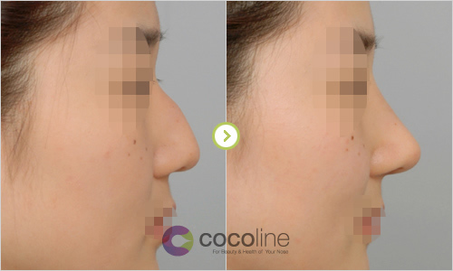 韩国cocoline整形外科驼峰鼻矫正案例