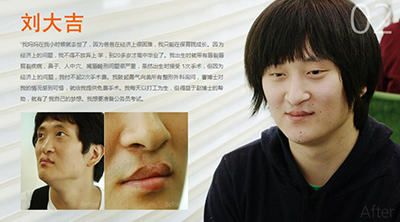 韩国美所有整形外科唇腭裂矫正