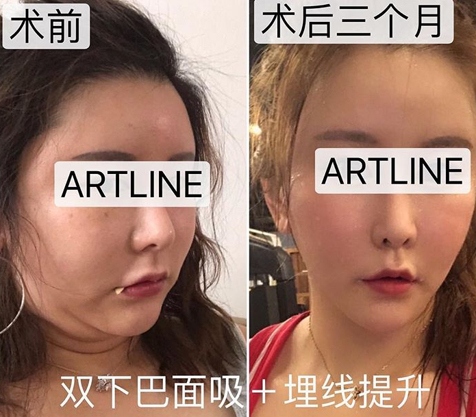 韩国artline整形外科埋线提升案例图