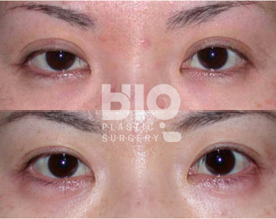 韩国BIO整形外科双眼皮修复特点展示