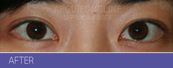韩国双眼皮提肌手术日记对比