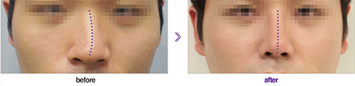 韩国延世PLUS整形医院歪鼻矫正手术案例展示