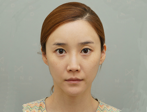韩国mind整形外科隆鼻术前案例
