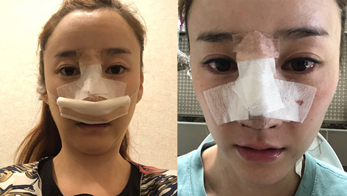 韩国mind医院隆鼻术后恢复图