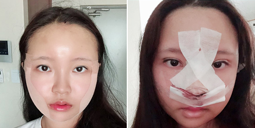 韩国mind医院面部轮廓术后恢复照片