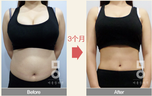 韩国美尔韩方医院吸脂瘦身对比案例对比