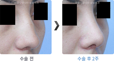 韩国吴金斯整形外科鹰钩鼻矫正手术案例如下图