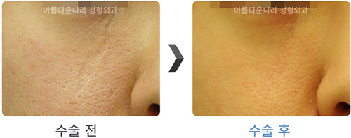 韩国吴金斯整形外科面部祛疤手术对比案例展示