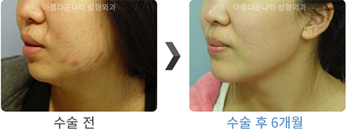 韩国吴金斯整形医院面部吸脂手术对比案例展示