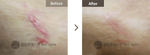 韩国清潭珠颜整形医院祛疤手术对比日记展示