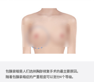 隆胸修复动画示意图