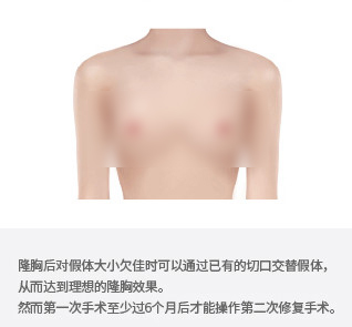 韩国TL假体隆胸修复图片