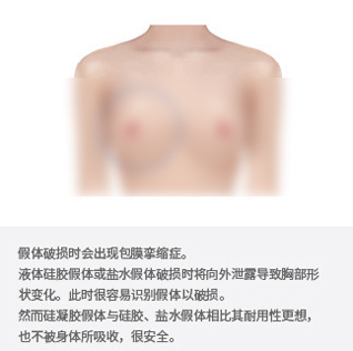 韩国TL假体隆胸修复