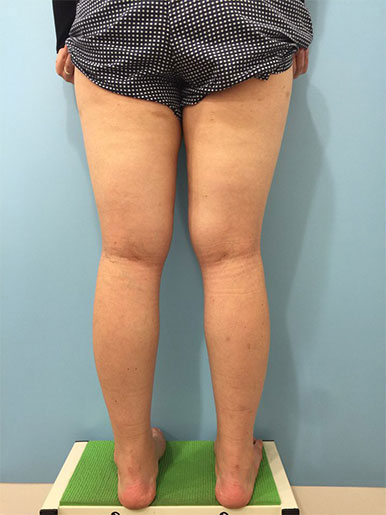 韩国G皮肤科大腿吸脂案例对比