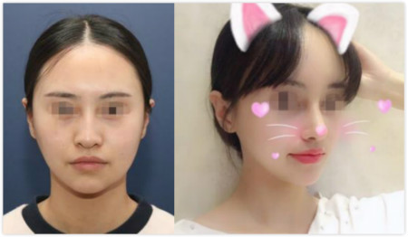 韩国nano医院鼻整形手术对比图